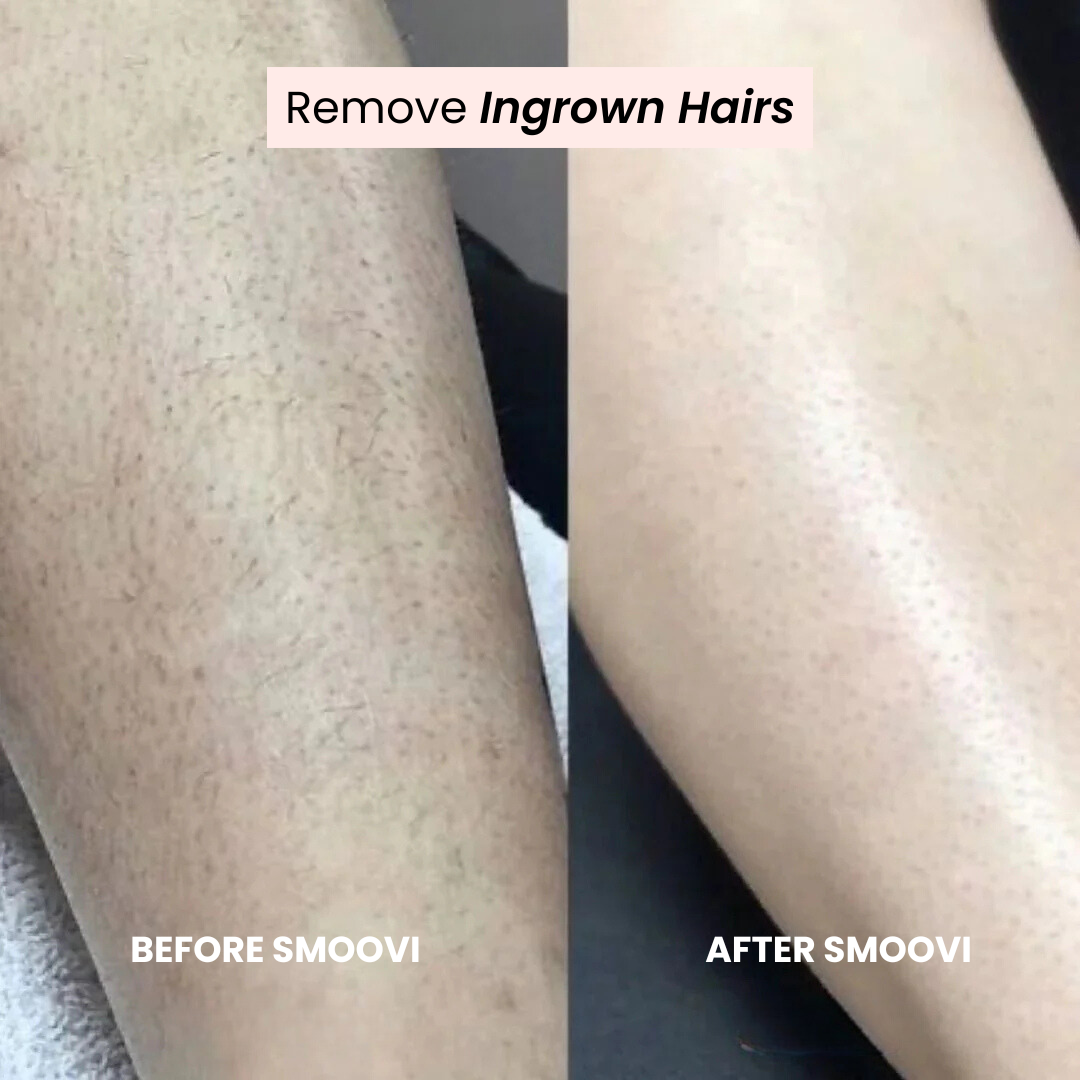 PetalSmooth™ SMOOVI 2.0